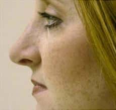 Female Rhinoplasty