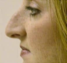 Female Rhinoplasty