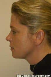 Neck Liposuction