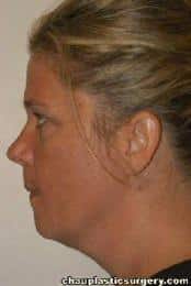 Neck Liposuction
