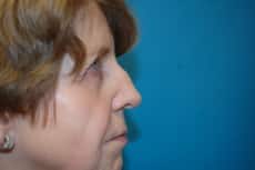 Rhinoplasty on Female Patient