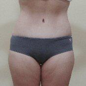 Tummy Tuck for 26-Year-Old Woman
