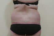 Flank Liposuction for Best Results