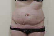 Abdominoplasty for Slim Figure