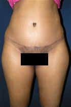 Tummy Tuck Has Successful Results