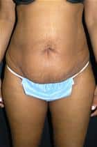 Tummy Tuck Has Successful Results