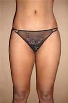 Liposuction of Flanks, Hips, Thighs and Butt
