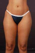 Liposuction of Flanks, Hips, Thighs and Butt